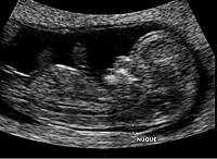 Ger�ek boyutunda g�r�nt�lemek i�in resme t�klay�n.

Ad�:  Nucal_thickness_11_weeks.JPG
G�sterim: 100
Boyutu:  27.5 KB