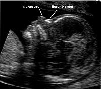 Ger�ek boyutunda g�r�nt�lemek i�in resme t�klay�n.

Ad�:  14._haftadaki_bir_bebe�in_burun_kemi�i_incelemesi.jpg
G�sterim: 107
Boyutu:  24.6 KB