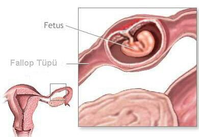 Ad:  ectopic.jpg
Gsterim: 787
Boyut:  16.6 KB