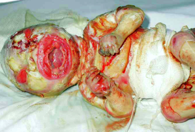 Ad: Harlequin_tipi_iktiyozis.PNG
Gösterim: 2382
Boyut: 549.4 KB