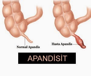 Ad: apandisit1.jpg
Gösterim: 840
Boyut: 12.5 KB