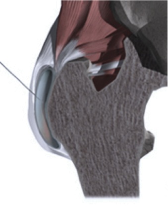 Ad:  trokanterikbursit.jpg
Gsterim: 1493
Boyut:  29.1 KB