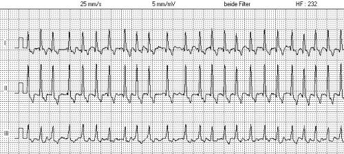 Ad:  Tachykardie1.jpg
Gsterim: 7311
Boyut:  45.0 KB