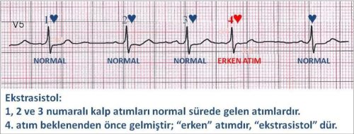 Ad:  extrasistol.jpg
Gsterim: 7030
Boyut:  27.5 KB