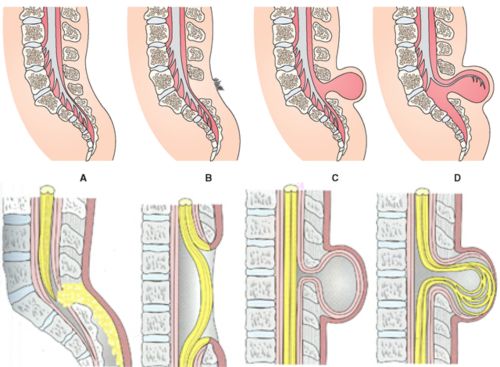 48087d1461550412 spina bifida ayrik cikik omurga spb1