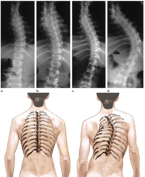 Ad: skoliozis1.jpg
Gösterim: 2083
Boyut: 45.5 KB