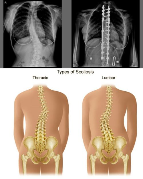 Ad: skoliozis2.jpg
Gösterim: 2213
Boyut: 38.3 KB
