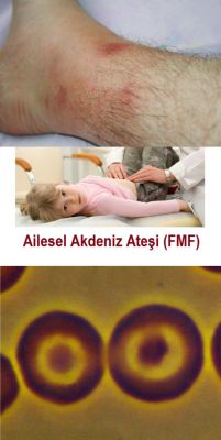 Ad: Ailevi Akdeniz Ateşi (Fmf)2.jpg
Gösterim: 2532
Boyut: 13.7 KB