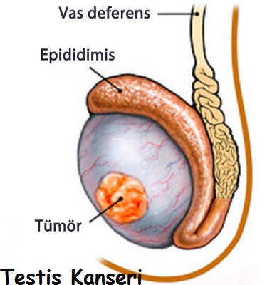 Ad: testis tümörü.jpg
Gösterim: 3208
Boyut: 55.4 KB Ad: testis tümörü.jpg
Gösterim: 3208
Boyut: 55.4 KB