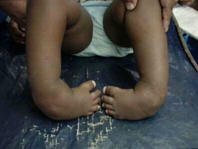 Ad: çarpık ayak.jpg
Gösterim: 706
Boyut: 80.4 KB