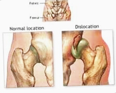 Ad: kalça çıkığı.jpg
Gösterim: 720
Boyut: 32.4 KB
