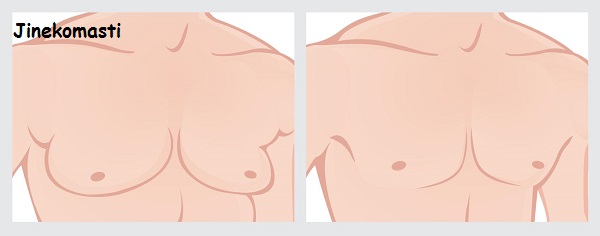 Ad:  jinekomasti ameliyat.jpg
Gsterim: 2252
Boyut:  22.6 KB