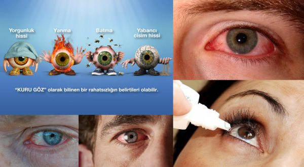 Ad:  Kuru Gz Hastal.jpg
Gsterim: 1285
Boyut:  35.5 KB