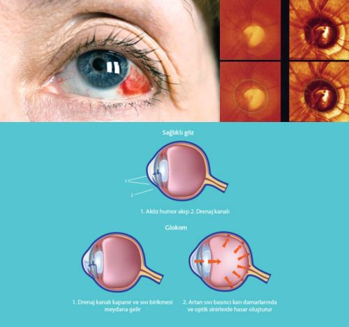 Ad:  glokom1.jpg
Gsterim: 2081
Boyut:  29.1 KB