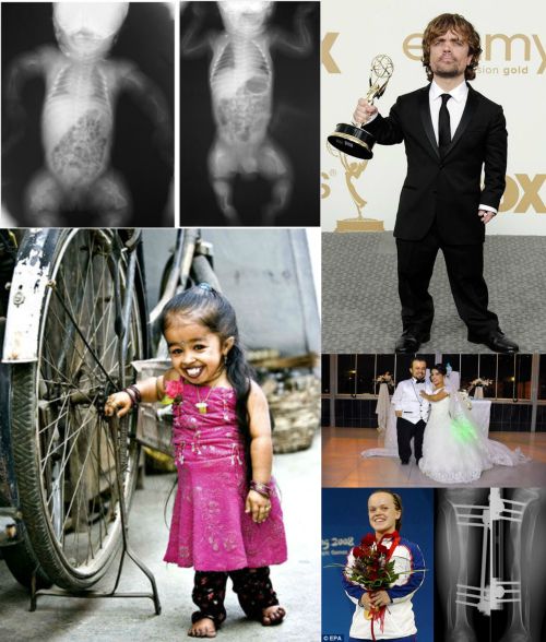 Ad:  Akondroplazi1.jpg
Gsterim: 5024
Boyut:  62.7 KB