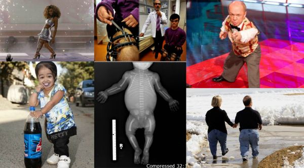 Ad:  Akondroplazi2.jpg
Gsterim: 3885
Boyut:  45.3 KB