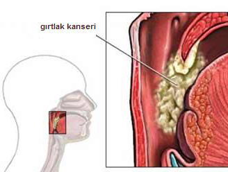 Ad: Gırtlak Kanseri.jpg
Gösterim: 283
Boyut: 15.6 KB