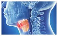 Ad: Gırtlak Kanseri-4.jpg
Gösterim: 2274
Boyut: 8.6 KB