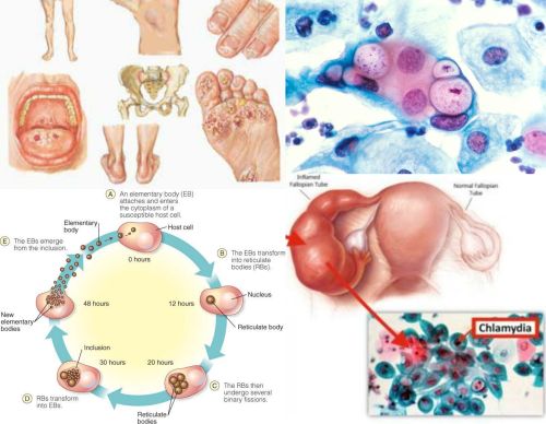 chlamydia klamidya belirtileri tedavileri ve gercekler