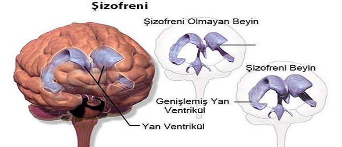 Ad:  sizofreni.jpg
Gsterim: 6902
Boyut:  69.8 KB
