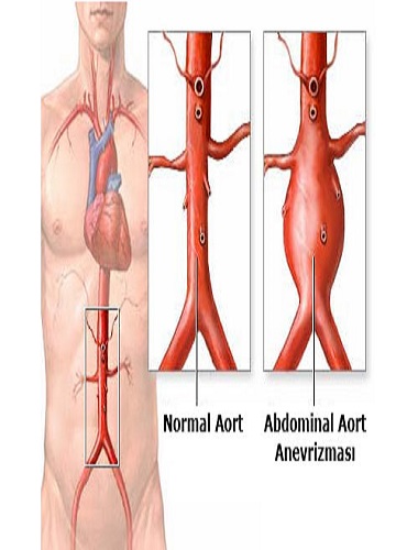 Ad:  aort abdominal.jpg
Gsterim: 2863
Boyut:  49.8 KB