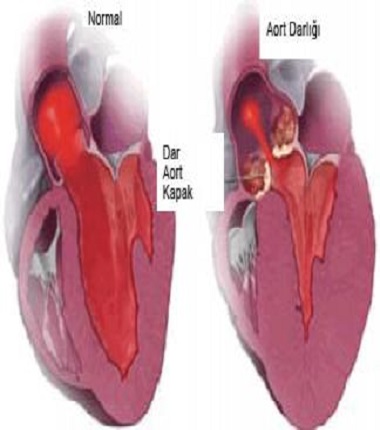 Ad:  aort-darligi.jpg
Gsterim: 1536
Boyut:  36.7 KB