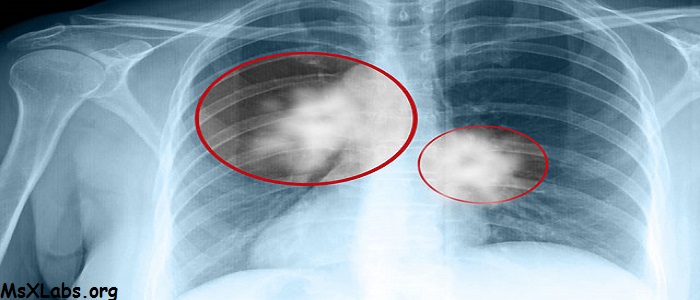 62794d1489747883 akciger kanseri akciger kanseri belirtileri 6657307