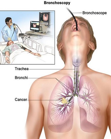 Ad:  akciger-kanseri-belirtileri.jpg
Gsterim: 1737
Boyut:  63.4 KB