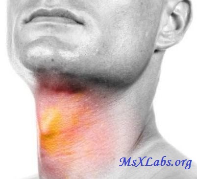 Ad: Gırtlak Kanseri.jpg
Gösterim: 2273
Boyut: 30.8 KB