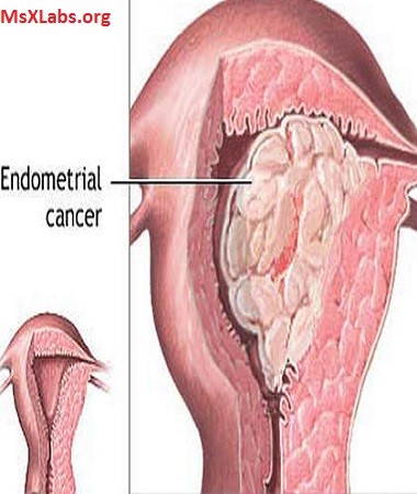Выскабливание цервикального канала шейки. Вакуумное выскабливание. Как называется чистка эндометрия. Вакуумное выскабливание. Как называется чистка эндометрия.