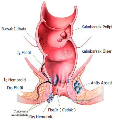 Ad:  hemoroid-tedavisi.jpg
Gsterim: 1269
Boyut:  77.7 KB