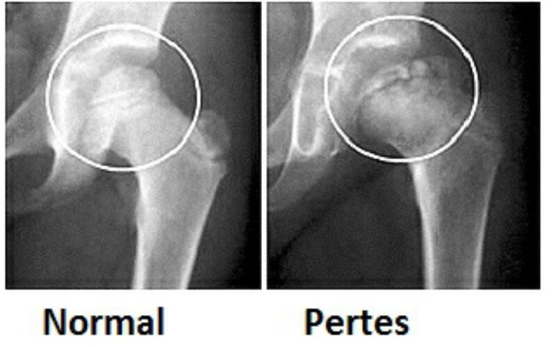 64918d1501699584 perthes hastaligi pertes hastaligi 800x499 - Perthes hastalığı hakkında bilgi verebilir misiniz? 64918d1501699584 perthes hastaligi pertes hastaligi 800x499