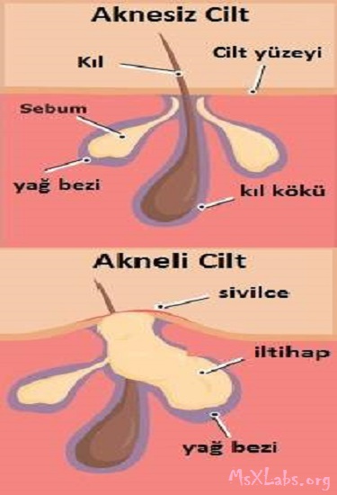 Ad:  akne-rnegi.jpg
Gsterim: 1185
Boyut:  52.7 KB