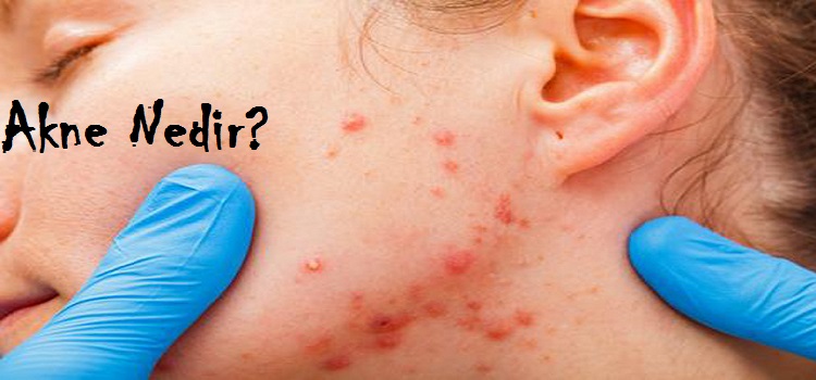 65266d1505544914 akne vulgaris sivilce akne