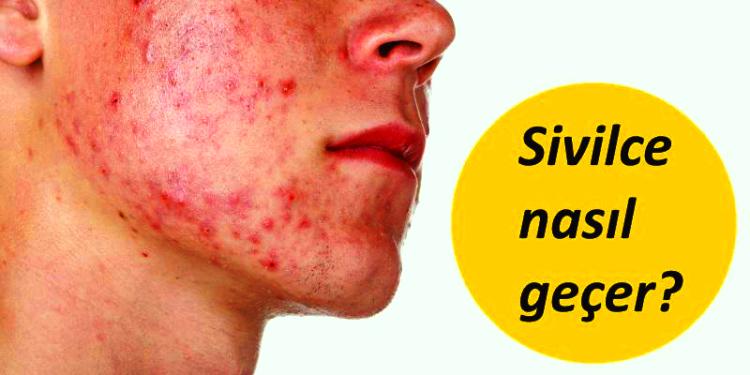 65268d1505545975 akne vulgaris sivilce sivilce nasil gecer sivilce izleri neden olusur