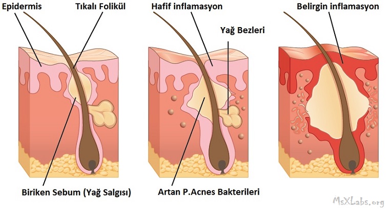 Ad:  Sivilce-Olusumu.jpg
Gsterim: 440
Boyut:  125.0 KB
