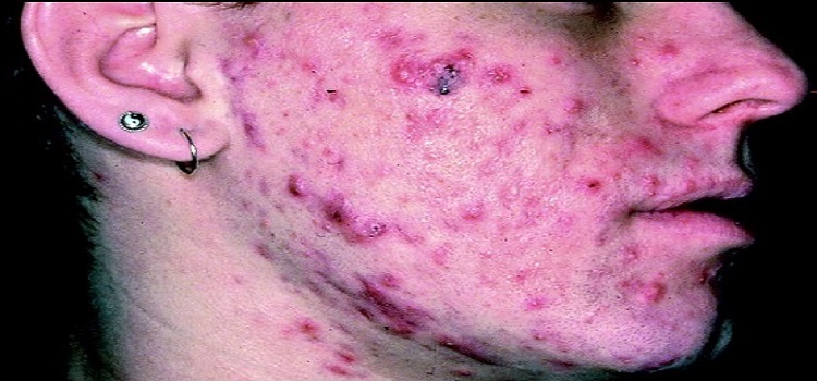 Ad:  Siddetli-Akne.jpg
Gsterim: 1617
Boyut:  95.4 KB