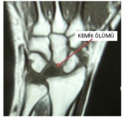 Ad:  Kienbck2.JPG
Gsterim: 862
Boyut:  17.8 KB