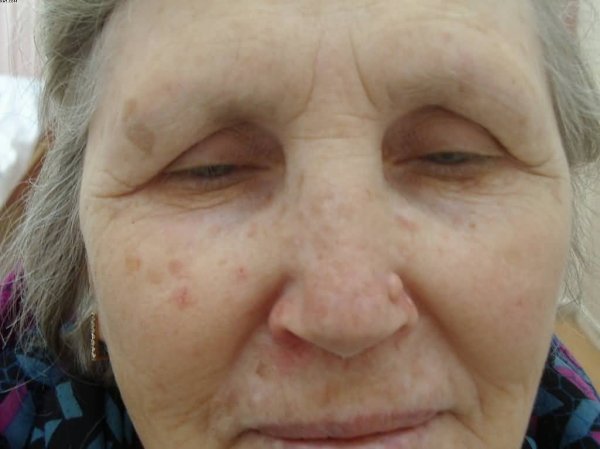 Ad: aktinik_keratoz_1.jpg
Gösterim: 1586
Boyut: 34.8 KB