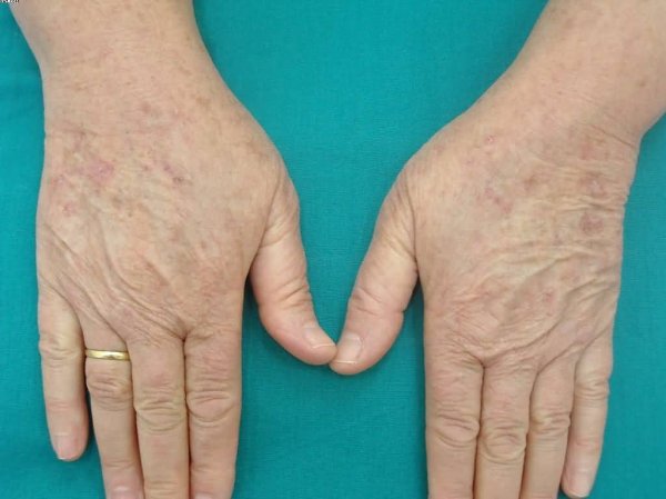 Ad: aktinik_keratoz_2.jpg
Gösterim: 1096
Boyut: 39.1 KB