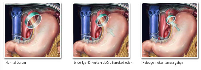 Reflü Gastro Özofageal Reflü (Mide Reflüsü)